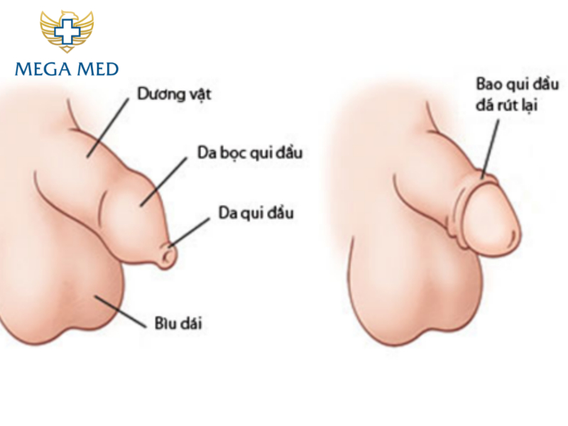 Hiện tượng hẹp bao quy đầu